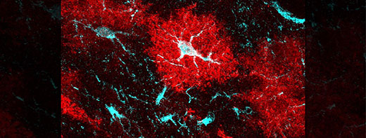 Links between unsung brain cells and Huntington’s disease